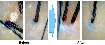 毛穴の詰まりがなくなっています。 毛穴の詰まりがなくなっています。